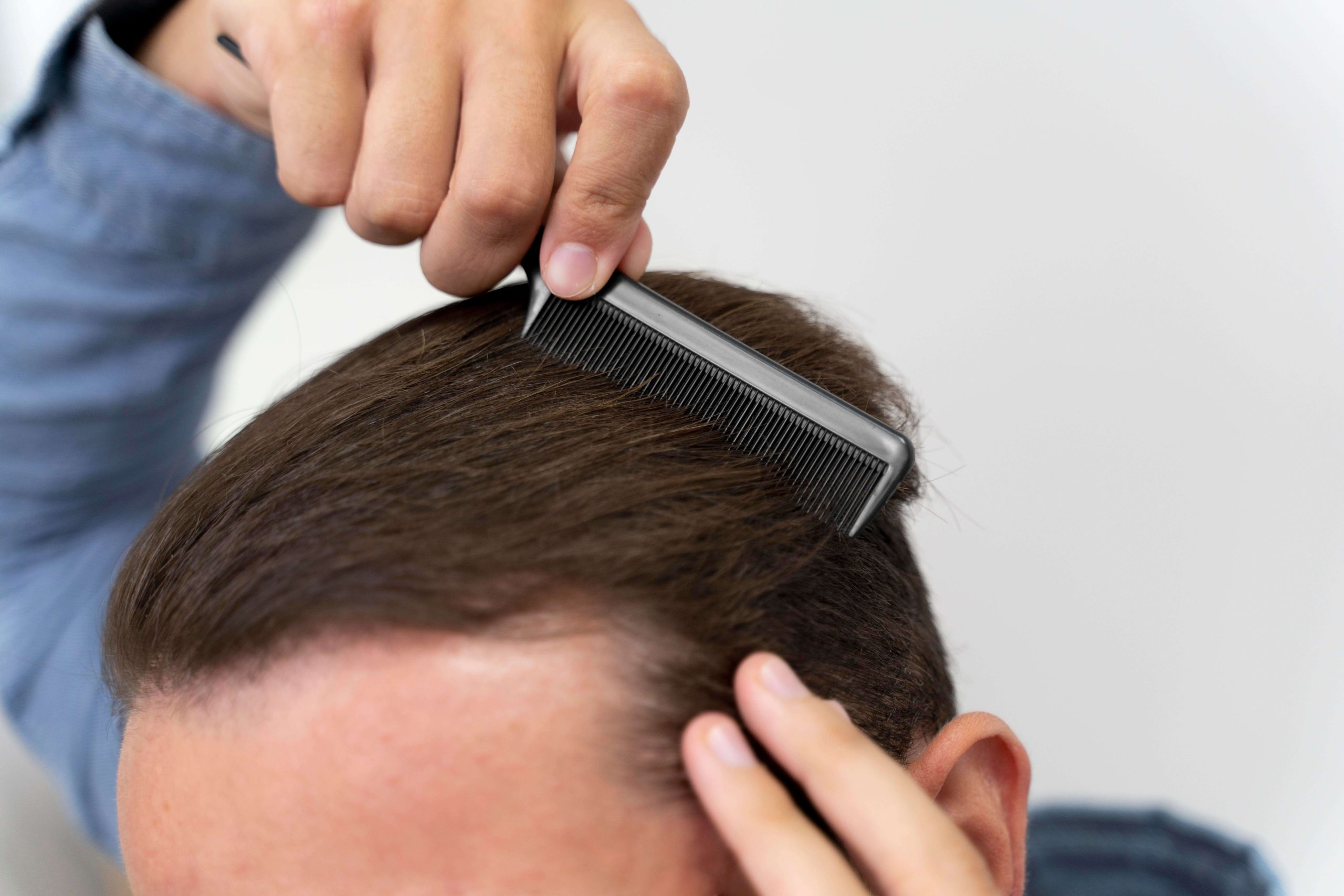 Solución a la caída del cabello de patrón masculino: trasplante de cabello