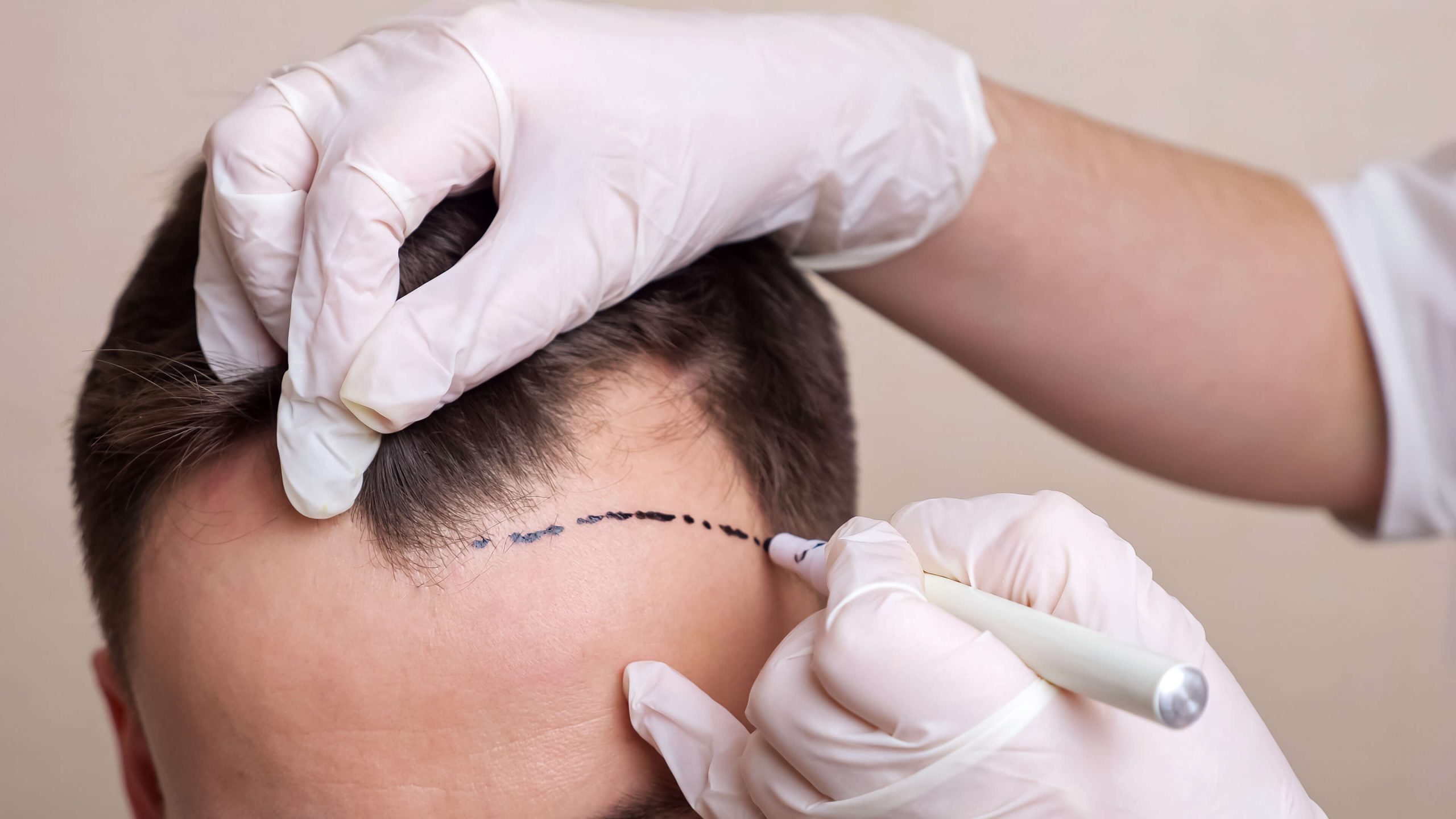 What is Stem Cell Assisted Hair Transplantation?